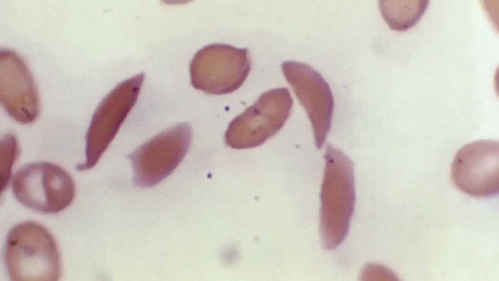 Sickle cell gene therapies offer new hope, but access remains a major challenge